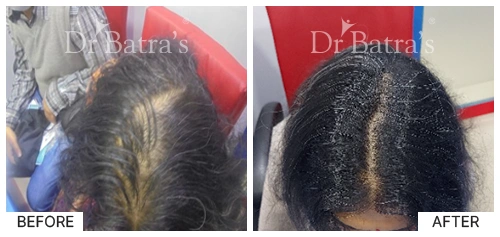 Hair Falling Treatment